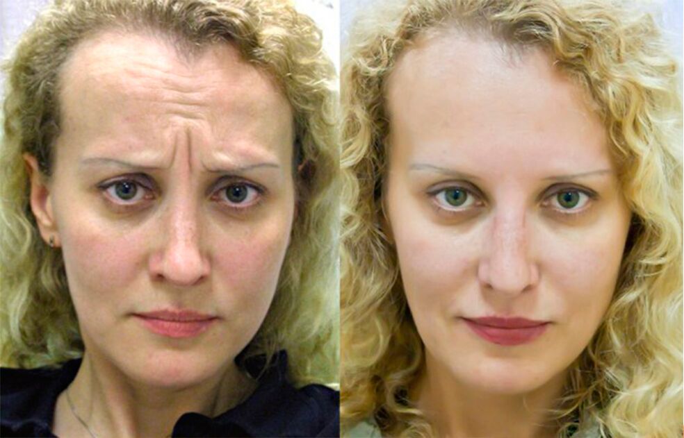 før og efter brug af massageapparatet til foryngelse ltza foto 1