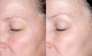 foryngelse af huden omkring øjnene før og efter fotos