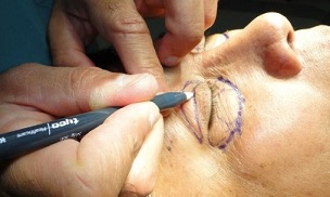 hvordan man kan forynge huden omkring øjnene