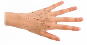 Injektionssteder for hænder under biorevitalisering