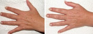 Resultatet af fjernelse af alderspletter på hænderne