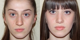 før og efter plasma hudforyngelse